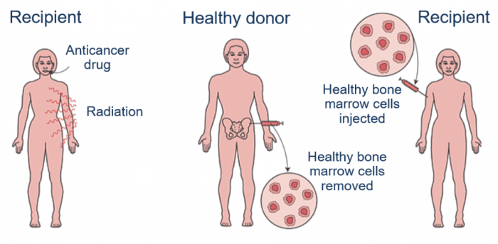 bone marrow fix